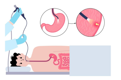 Эзофагогастродуоденоскопия (ЭГДС)